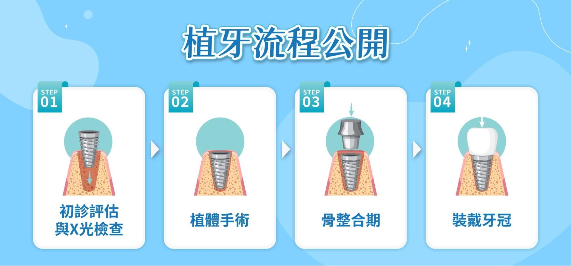 植牙流程說明