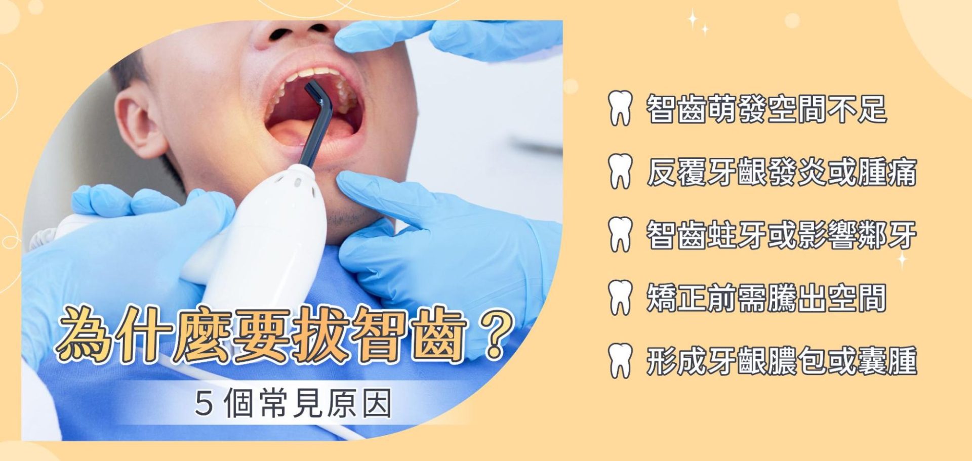 為什麼要拔智齒的常見原因
