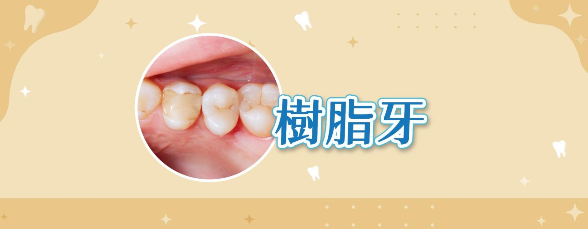 樹脂牙|臨時用 or 活動假牙的常見材質