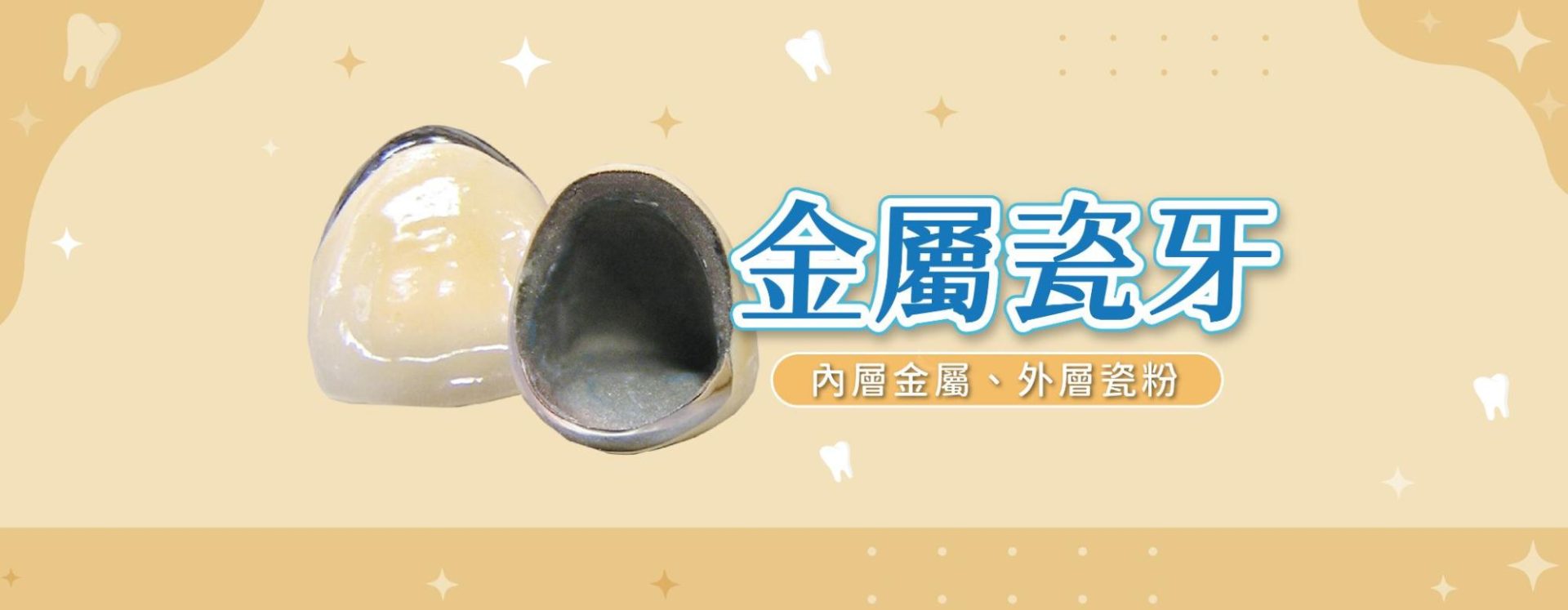 金屬瓷牙(燒瓷牙)|美觀+耐用的中間選擇