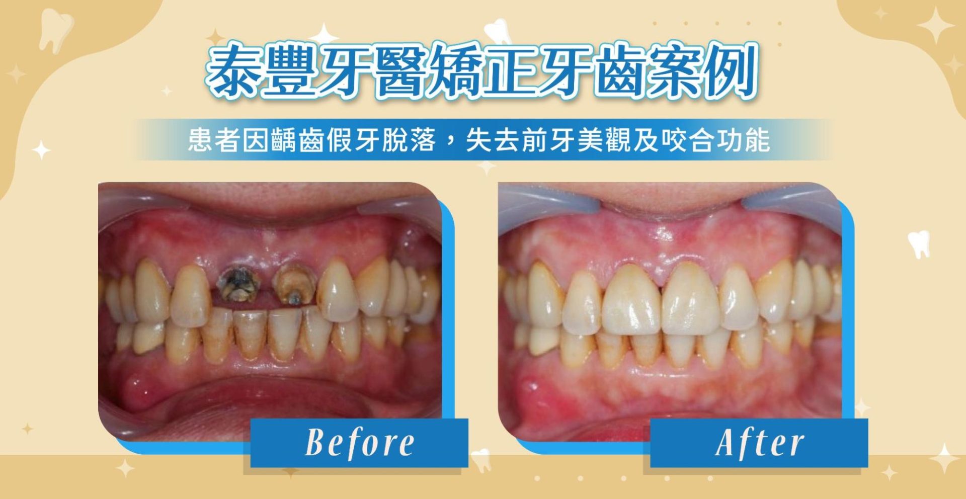 DSD 微笑設計和傳統牙齒美學療程差在哪