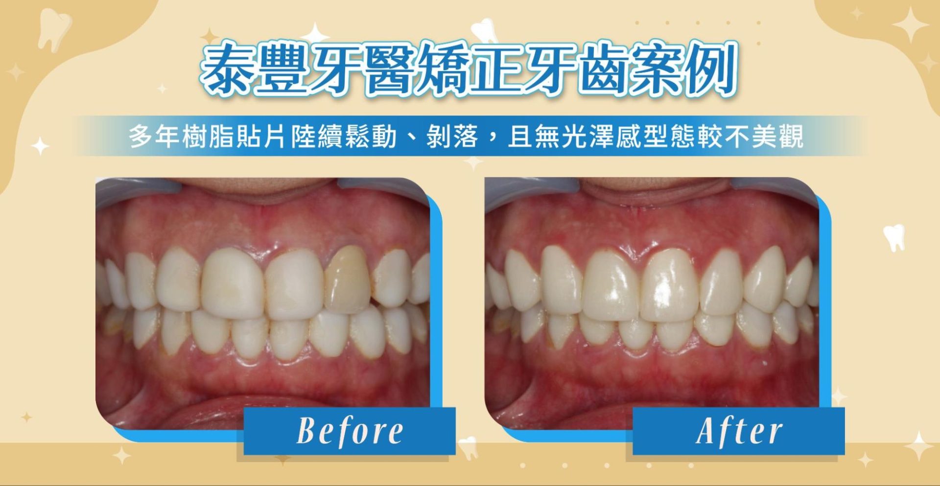 DSD 微笑設計和傳統牙齒美學療程差在哪
