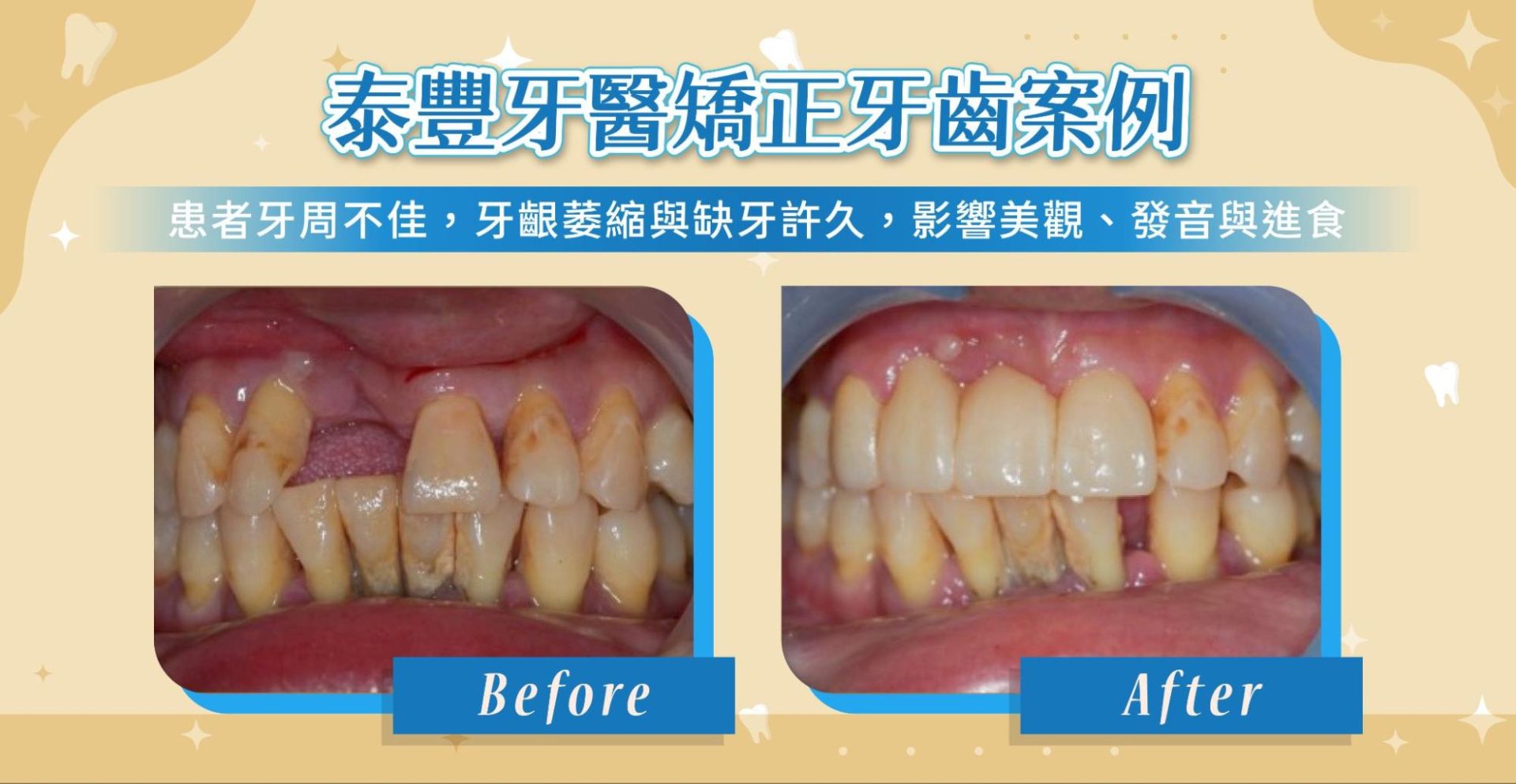DSD 微笑設計和傳統牙齒美學療程差在哪
