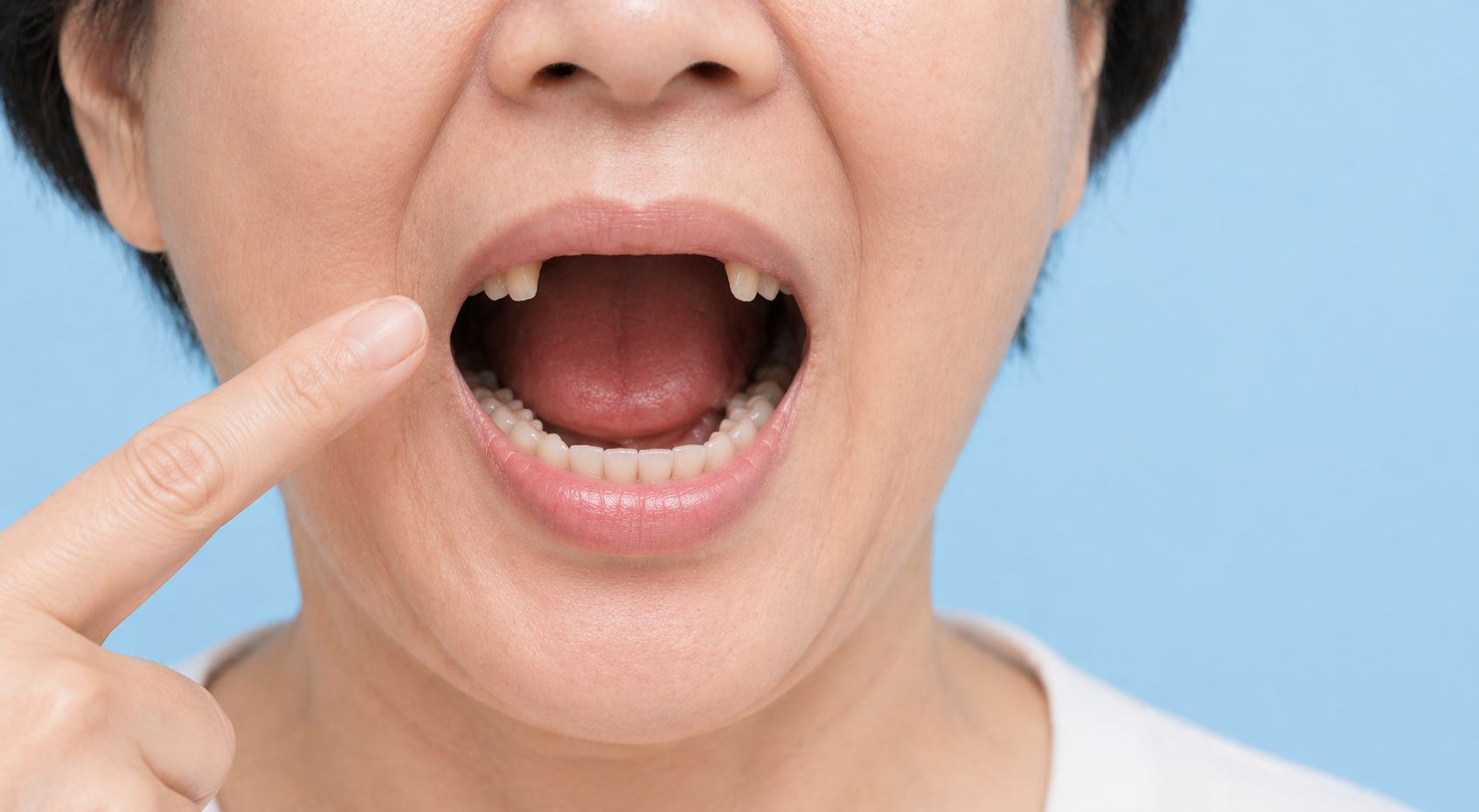 缺牙一定要做活動假牙？患者最常問的第一個問題