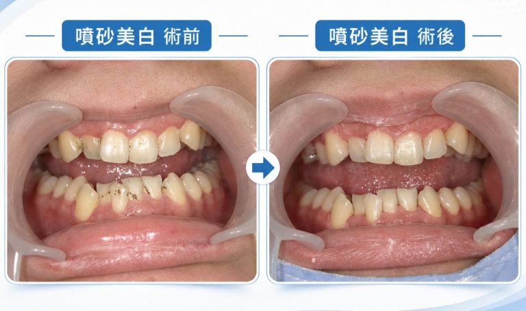 噴砂美白術前/術後比較
