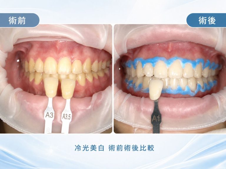 冷光美白術前A3至A3.5與療程後A1齒色比較