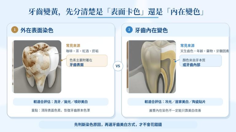 牙齒外在表面染色與內在變色差異及適合的牙齒美白方式比較