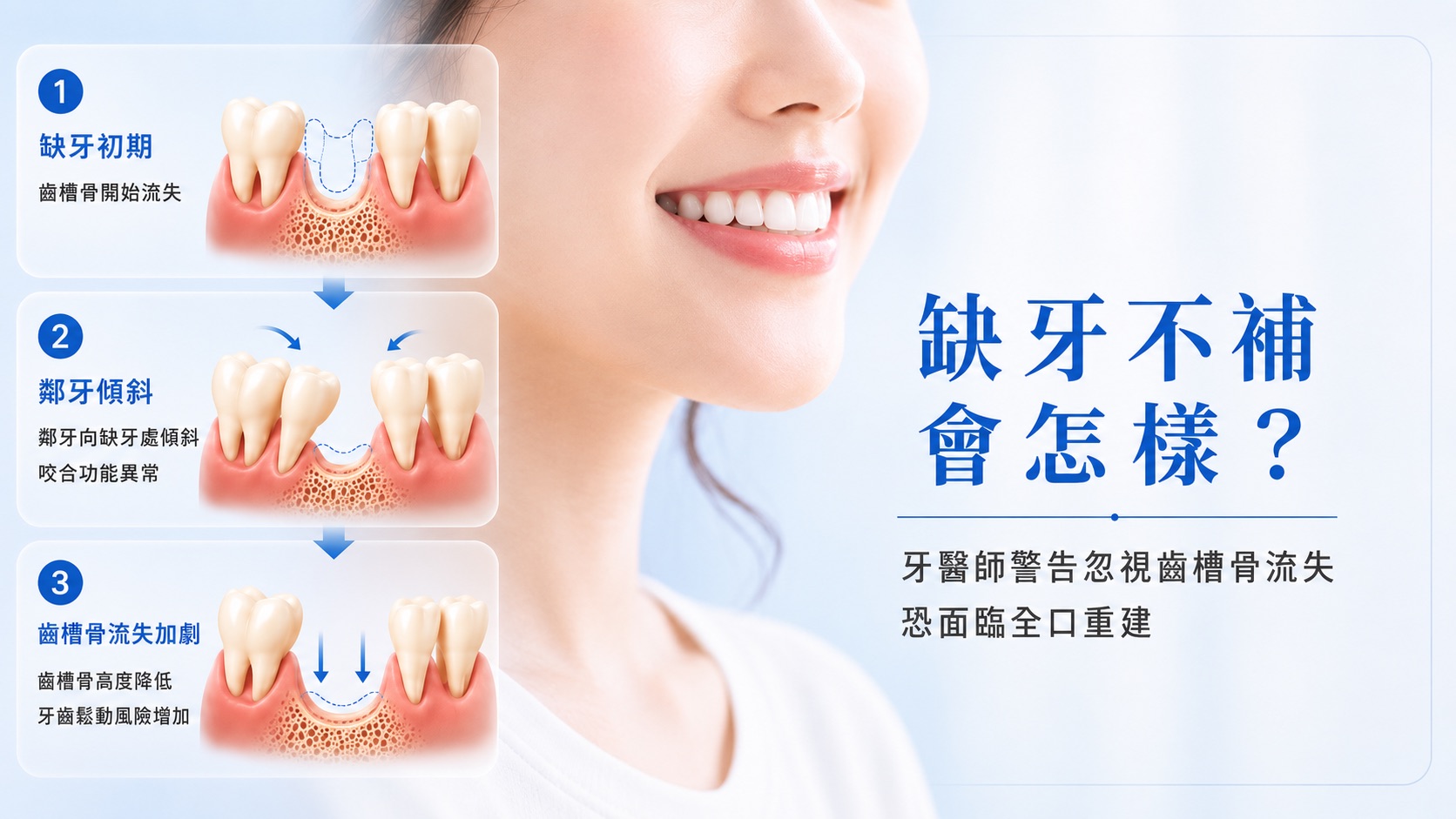 缺牙不補造成齒槽骨流失與咬合改變示意圖