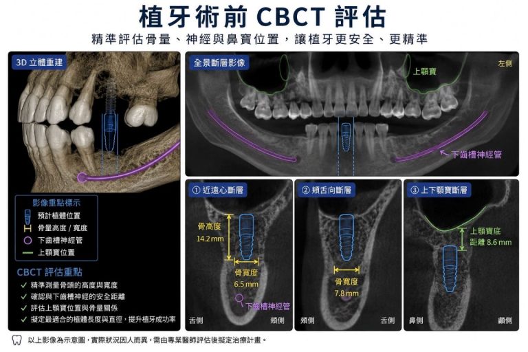 泰豐牙醫數位植牙術前CBCT評估骨量神經與鼻竇位置