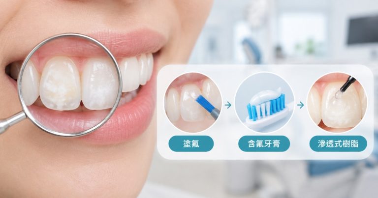 牙齒出現黃白色、粉筆白斑塊，要先確認是不是脫鈣白斑