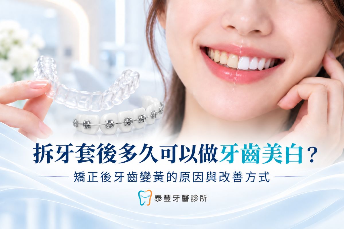 拆牙套後多久可以美白？矯正後牙齒變黃的原因與改善方式｜桃園泰豐牙醫