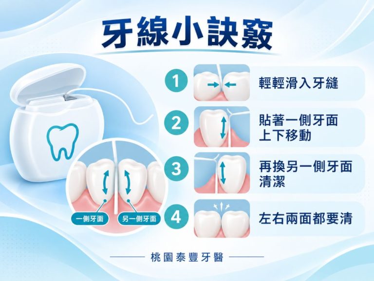 牙線清潔四步驟示意圖,說明牙線滑入牙縫、貼著左右牙面上下移動的使用方式